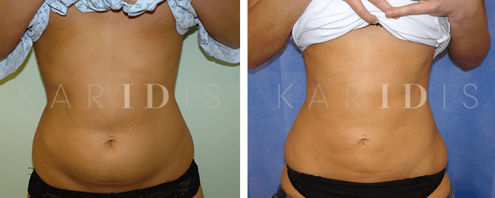 Liposuction Before & After Results UK