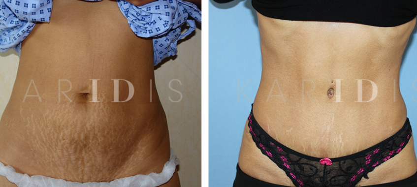 Tummy Tuck Before & After Gallery: Patient 3