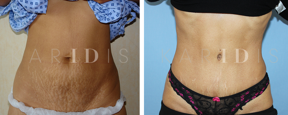 Abdominoplasty (Tummy Tuck) Before and After Examples