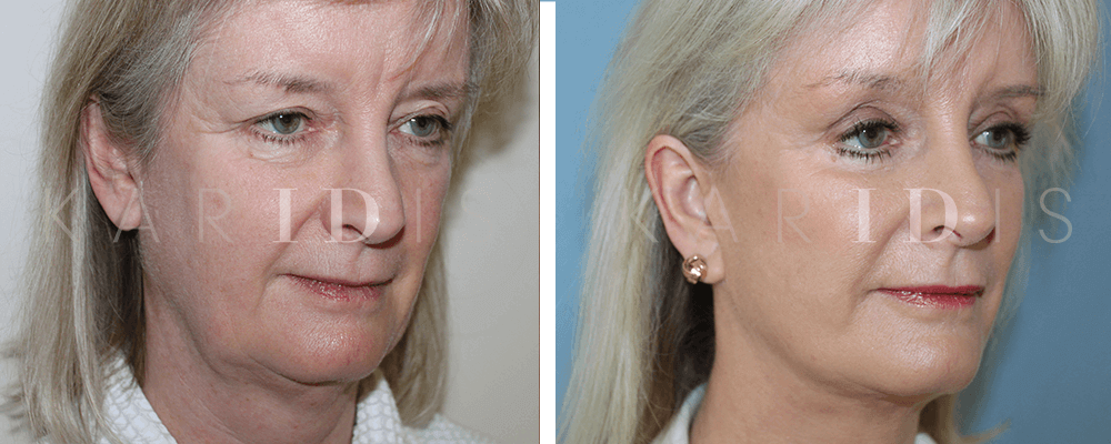 Before and After Photos | Mid Face Lift | Karidis